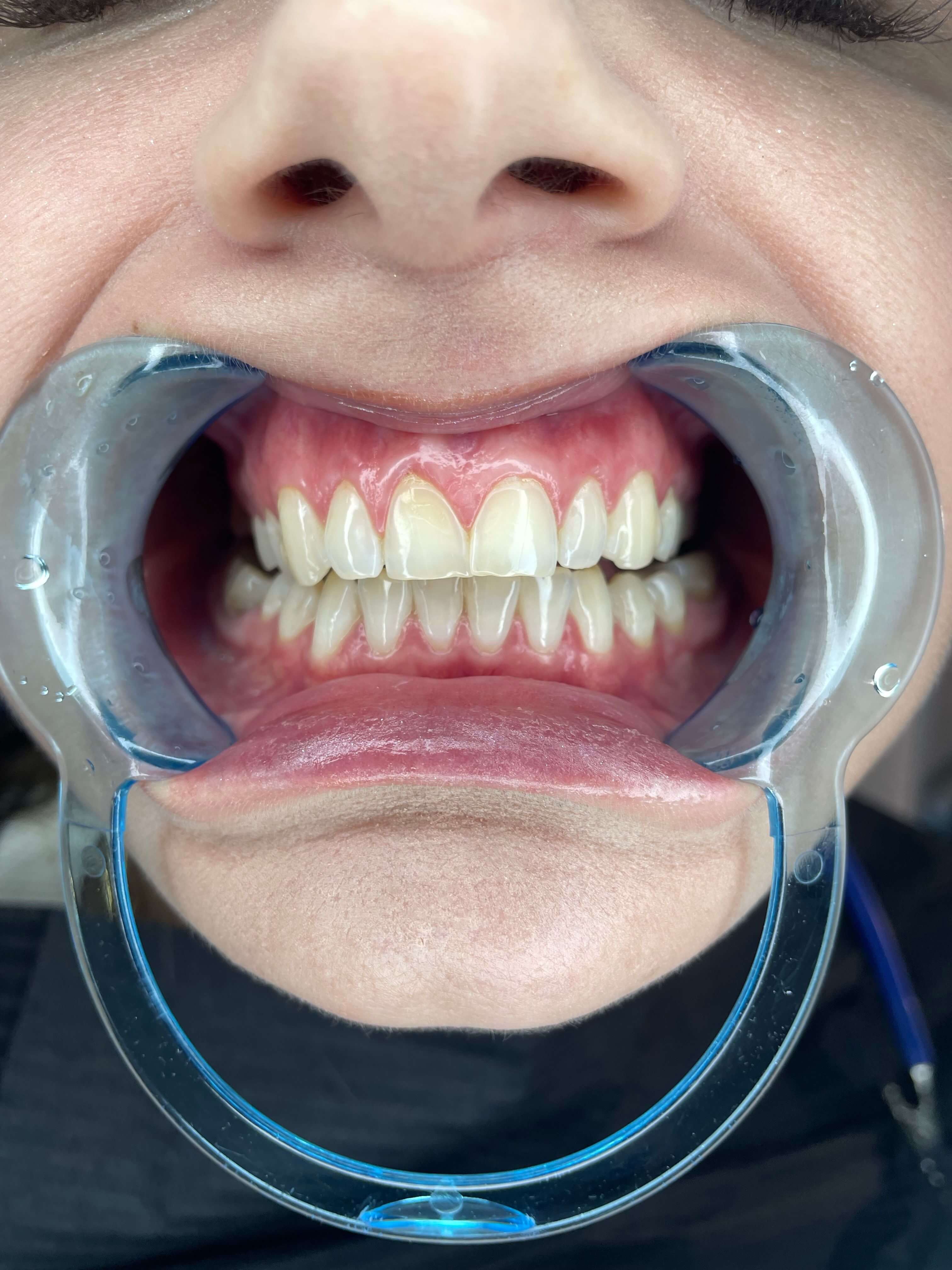 Depois do tratamento odontológico